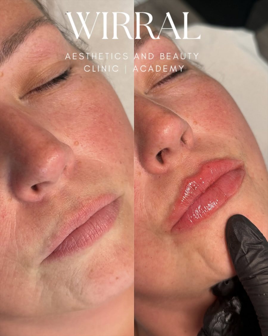 Lip enhancement carried out by Chantelle at CK Beauty and Aesthetics in Heswall