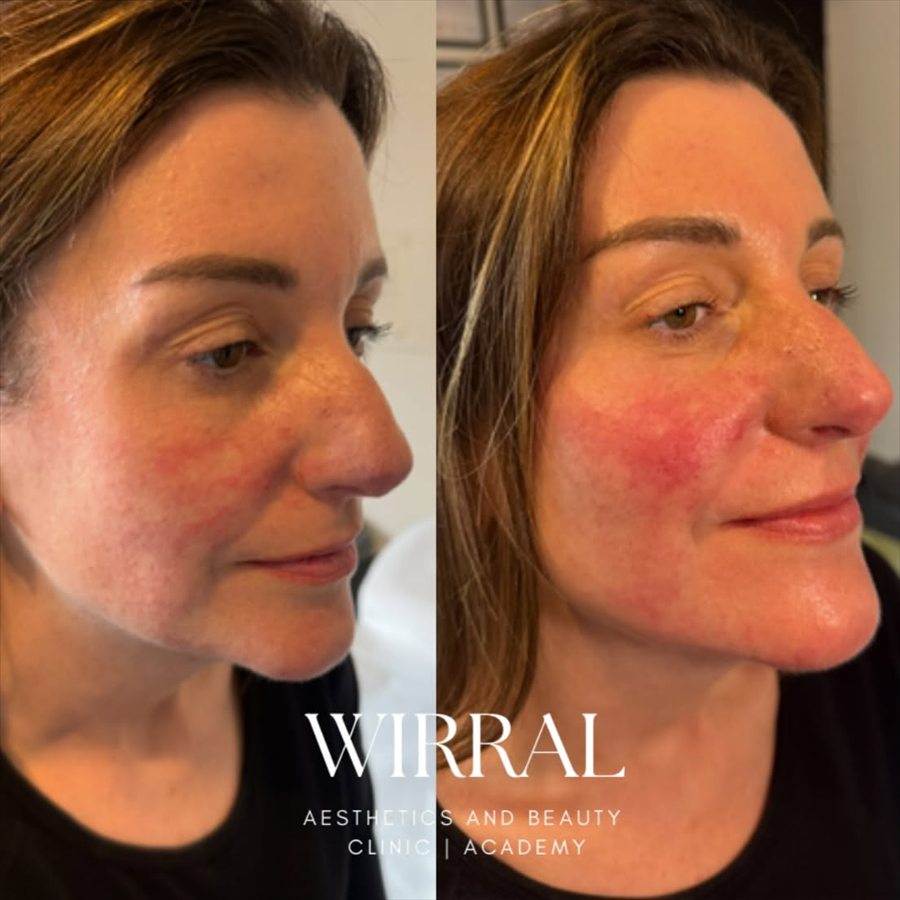 Skin treatment carried out by Chantelle at CK Beauty and Aesthetics in Heswall
